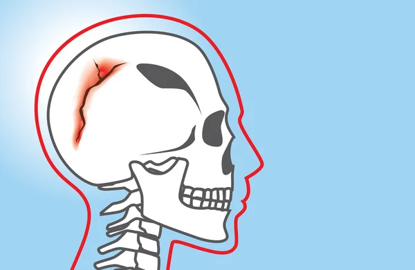 Fractura de cráneo humano — Vector de stock