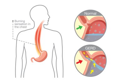 Cause of gastroesophageal reflux disease in human stomach clipart