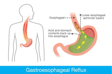 Cause of gastroesophageal reflux disease in human stomach clipart