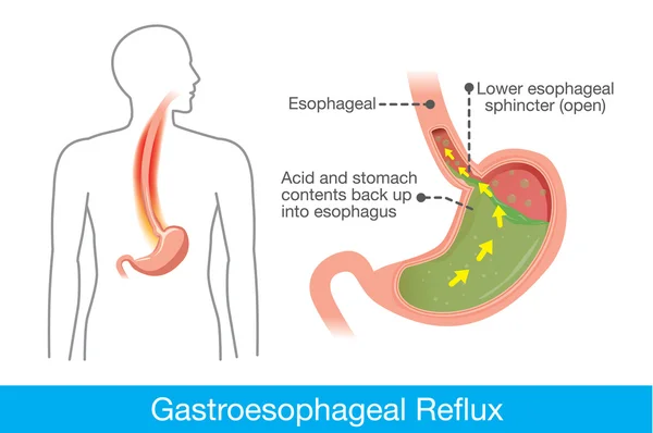 Orsaken till gastroesofageal refluxsjukdom i människans mage — Stock vektor