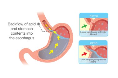 Acid in stomach back up into esophagus clipart