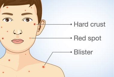 Diagram of the varicella infection in a child. clipart