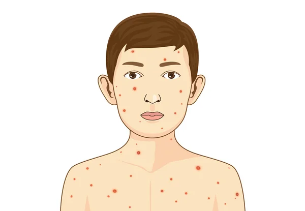 Child get chickenpox disease. — Stock Vector