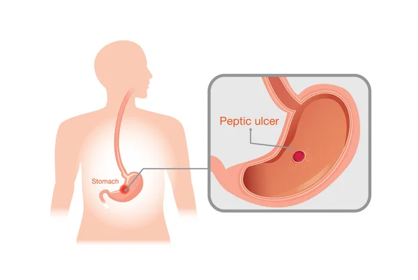 Image rapprochée de l'ulcère gastro-duodénal — Image vectorielle