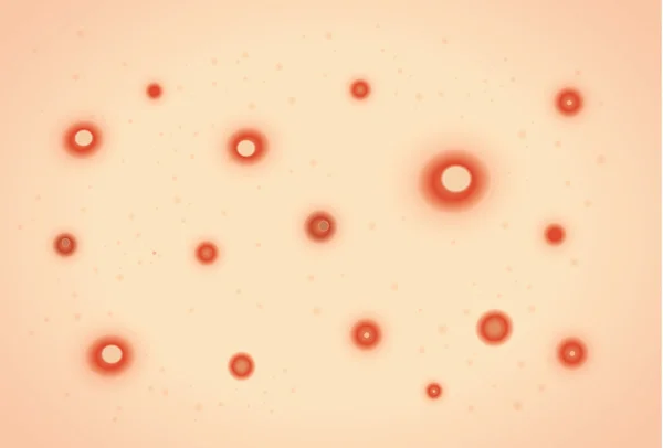 Itchy rash and red spots or blisters from chickenpox — Διανυσματικό Αρχείο