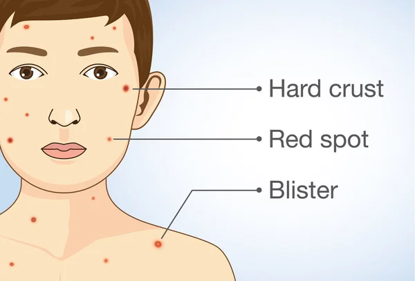 Diagram över varicella infektion hos ett barn. — Stock vektor