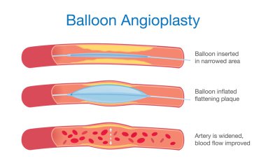 Balloon angioplasty procedure clipart