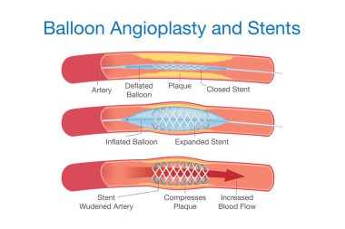 Balon anjiyoplasti ve Sstents yordamı