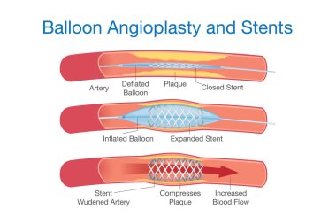 Balloon angioplasty and Sstents procedure clipart