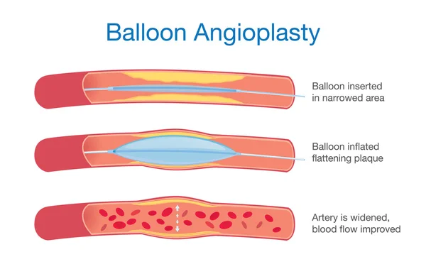 Angioplastia con balón — Archivo Imágenes Vectoriales