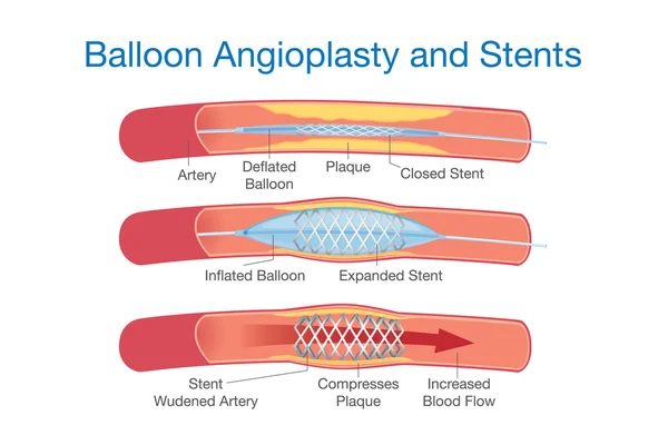 Angioplastia con balón y procedimiento de stents — Vector de stock