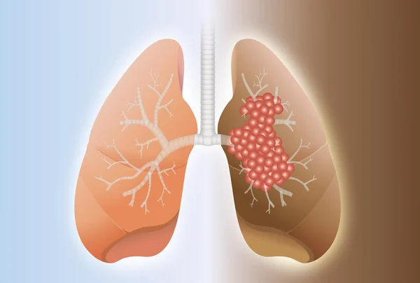 Pulmão saudável e pulmão com câncer —  Vetores de Stock