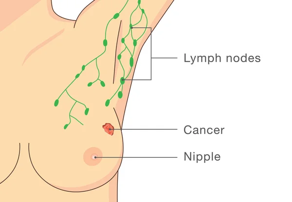 Žena má rakovinu prsu infekce. — Stockový vektor