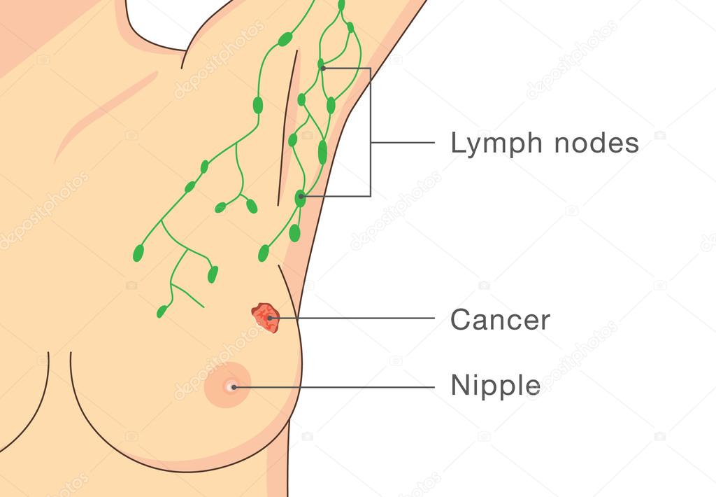 breast cancer infections Breast cancer infections