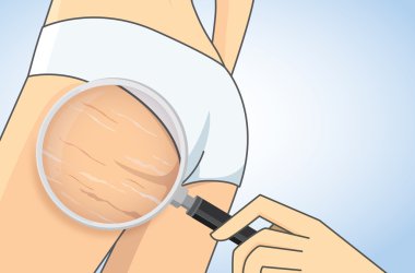 Zoom in stretch marks on buttocks with magnifier clipart