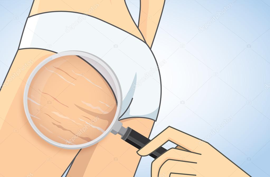 Zoom in stretch marks on buttocks with magnifier