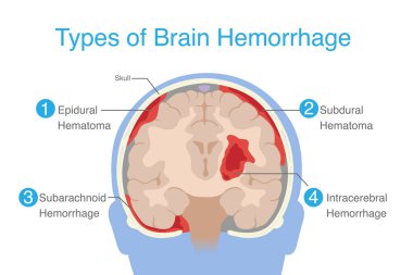 Epidural kanama, subdural, subaraknoid ve intraparenkimal dahil olmak üzere 4 tip beyin kanaması. Beyin kanamasının anatomisi..