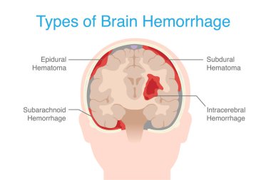 Kafatasında Epidural kanama, Subdural, Subaraknoid ve Intraparenkimal beyin kanaması var. İnsan beyin kanamasının anatomisi.
