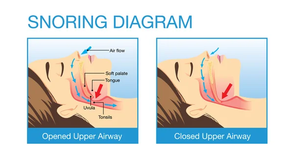 Anatomia das vias aéreas humanas enquanto ronca — Vetor de Stock