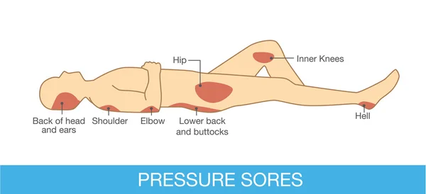 Pressure sores area — Stock Vector