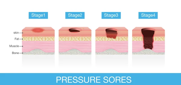 Stages of Pressure Sores — Stock Vector