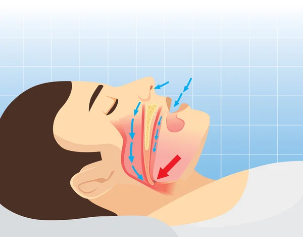 Anatomie van menselijke luchtweg tijdens het snurken — Stockvector