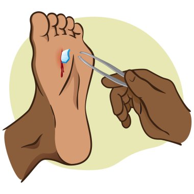 Yaralı kişi ayak Forseps ile çekerek kırık cam ile. Afrika kökenli. Kataloglar, bilgilendirme ve kurumsal kılavuzları için idealdir