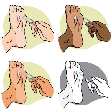Person injured foot with broken glass, pulling with forceps. ethnic. Ideal for catalogs, informational and institutional guides clipart