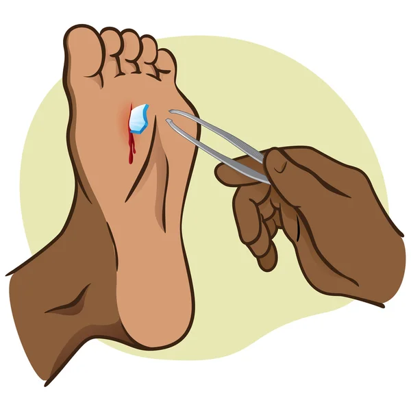 Person skadad fot med glaskross, dra med pincett. Afrikansk härkomst. Idealisk för kataloger, informativt och institutionella guider — Stock vektor