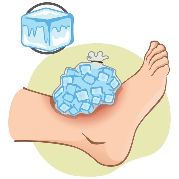 Illustrazione Pronto Soccorso persona caucasica, in piedi vista laterale, con impacco di ghiaccio. Ideale per cataloghi, informazioni e guide mediche — Vettoriale Stock