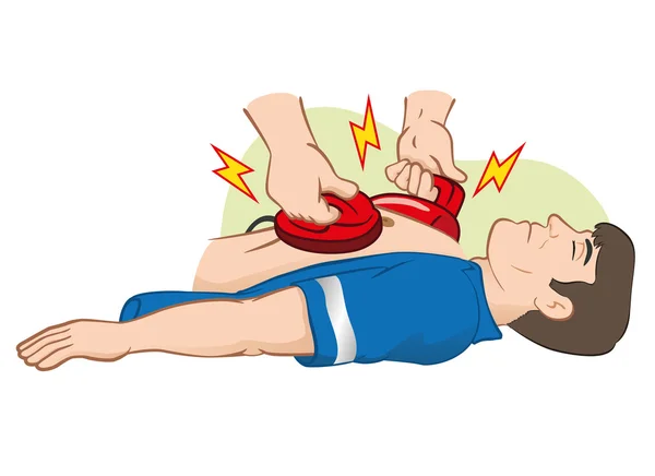 Illustrazione Rianimazione di pronto soccorso (CPR) utilizzando defibrillatore per arresto cardiaco. Ideale per la formazione di materiali, cataloghi e istituzionali — Vettoriale Stock