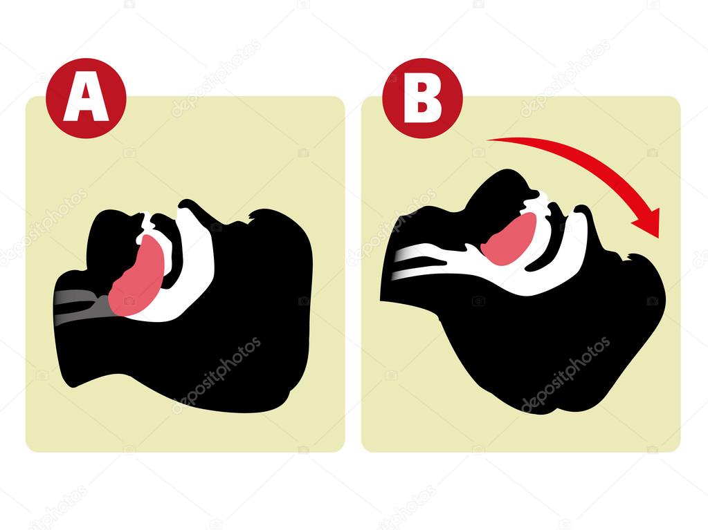 First Aid resuscitation (CPR), clearing breathing, mouth to mouth