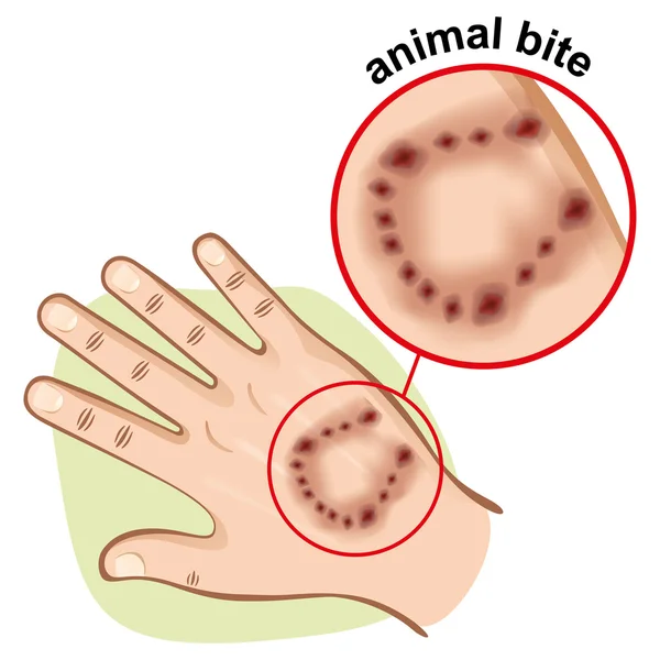 イラストは一部動物に刺された人間の体の手します。応急処置、医療機関の材料に最適 — ストックベクタ