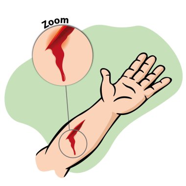 Illustration First Aid, injured arm with bleeding gash. Ideal for catalogs, newsletters and first aid guides clipart