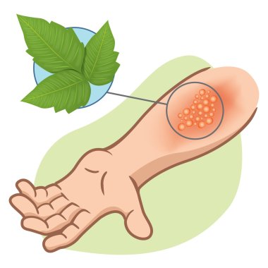 Illustration representing first aid arm with allergy and allergic rashes due to poison ivy poisoning clipart