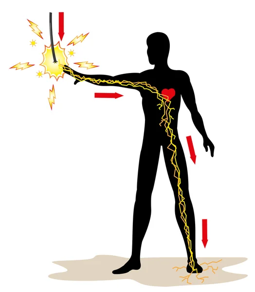 Ilustración que representa a una persona que recibe una descarga eléctrica en una red de alta tensión debido a un accidente de trabajo. Ideal para catálogos, boletines y guías de primeros auxilios — Archivo Imágenes Vectoriales