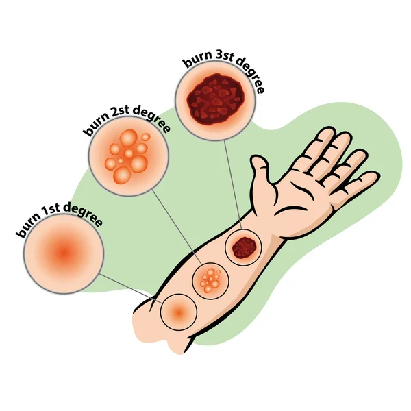 Ilustración Brazo de la persona de primeros auxilios con herida por quemadura. Ideal para catálogos, guías informativas y médicas — Vector de stock