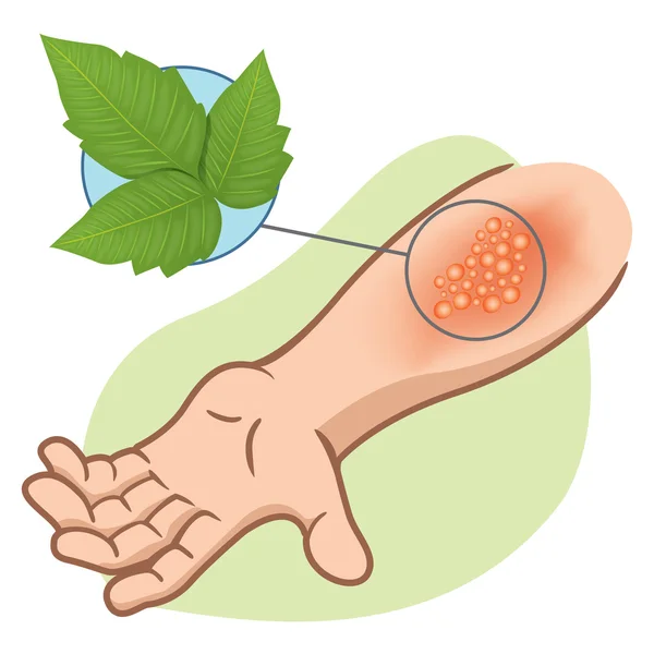 Illustration représentant un bras de premiers soins allergique et allergique à des éruptions cutanées dues à un empoisonnement au lierre empoisonné — Image vectorielle