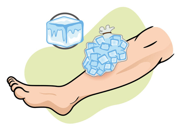Illustration representing First Aid with ice compress on the injured leg. Ideal for catalogs of medical, institutional and educational