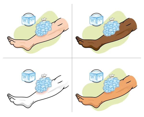 Illustration som representerar första hjälpen med ice omslagen på det skadade benet. Idealisk för kataloger av medicinsk, institutionella och pedagogiska — Stock vektor