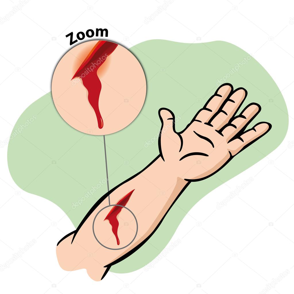 Illustration First Aid, injured arm with bleeding gash. Ideal for catalogs, newsletters and first aid guides