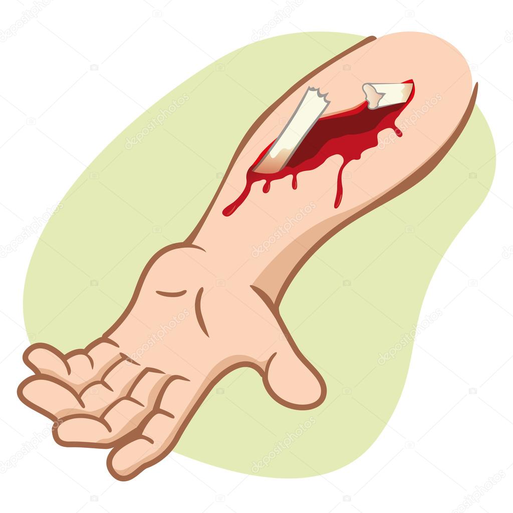 Illustration of a human arm with a compound fracture showing the broken bone. Ideal for catalogs, newsletters and first aid guides