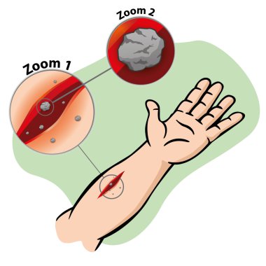 Illustration First Aid person arm cutting wound hole. Ideal for catalogs, informative and medical guides clipart