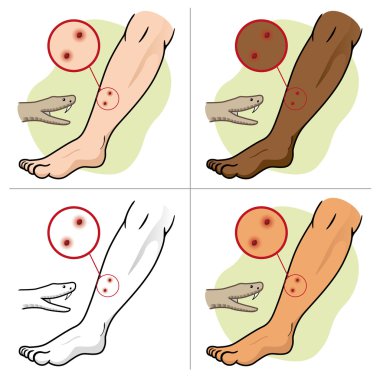 Illustration First Aid person chopped leg snake, etinias. Ideal for catalogs,informative and medical guides