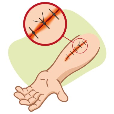 Illustration of a receiving first aid, injury or cut and sutured arm. Ideal for catalogs, information and first aid guides.
