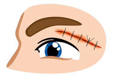 Illustration of a receiving first aid, injury or cut and sutured face. Ideal for catalogs, information and first aid guides