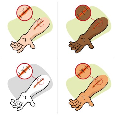Illustration of a receiving first aid, injury or cut and sutured arm. Ideal for catalogs, information and first aid guides clipart