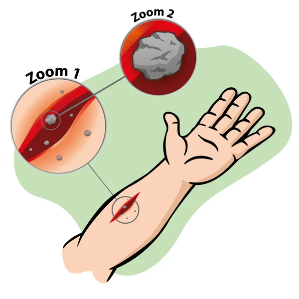 Ilustración Primeros auxilios persona brazo corte orificio de la herida. Ideal para catálogos, guías informativas y médicas — Vector de stock