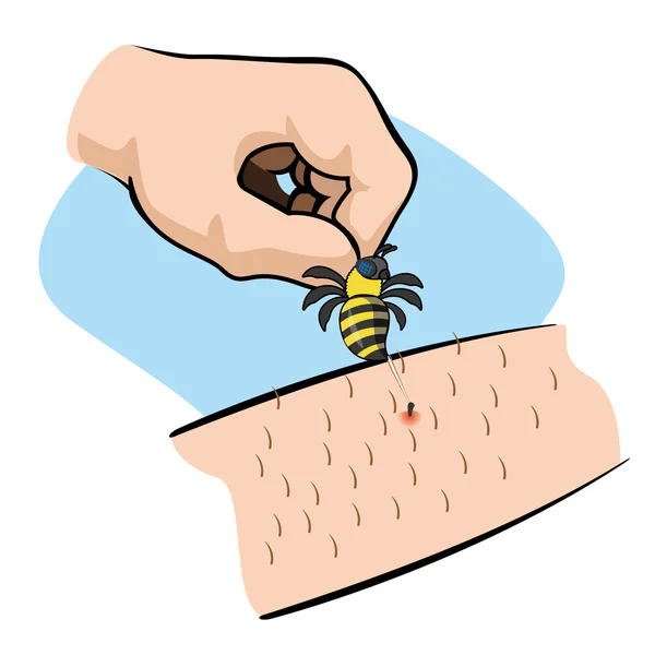 Illustration First Aid person bee sting arm. Ideal for catalogs, informative and medical guides