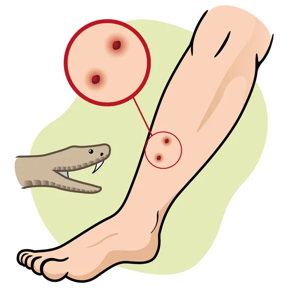 Ilustración La persona de primeros auxilios cortó la serpiente de la pierna. Ideal para catálogos, guías informativas y médicas — Vector de stock